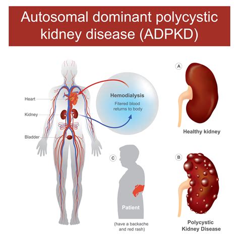 ADPKD - (dominante erfelijke polycystische nierziekte)